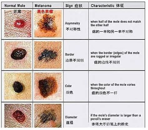 腰上長痣|腰上长痣好不好？腰上长痣代表什么？腰上有痣图解